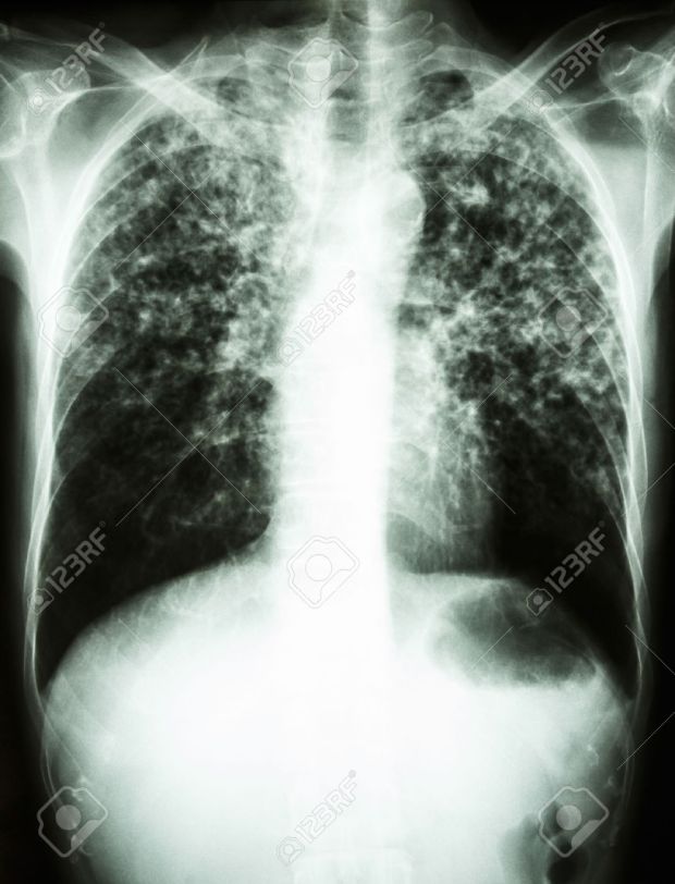 26045076-film-chest-x-ray-show-interstitial-infiltrate-both-lung-due-to-mycobacterium-tuberculosis-infection-stock-photo